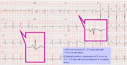 I- Abnormalities of ECG Waves and Segments P Wave Abnormalities: Biatrial Enlargement Large biphasic P wave in V1 with initial positive portion of the P wave greater than 1.