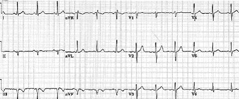 I- Abnormalities of ECG Waves and Segments QRS Abnormalities: Q