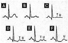I- Abnormalities of ECG Waves and Segments T Wave abnormalities T