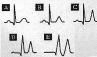 Ischaemia: T wave is inverted and symmetrical.