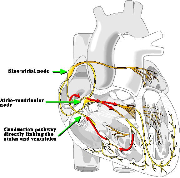 Pacemaker/Conduction Abnormalities Accessory Pathway or Wolf Parkinson White (WPW) Syndrome Abnormal, congenital extra pathways between the atria and ventricles or/and conduction tissue, and can