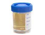 A 24 hour urine test is needed to assess for