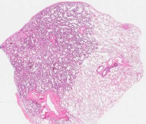 WHO Classification Lung Adenocarcinomas 2015 Minimally invasive adenocarcinoma (MIA) Adenocarcinoma in situ with <5mm scar 2015 WHO Classification Adenocarcinoma in situ Minimally invasive