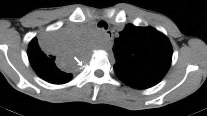 Computed tomography (CT) showed a large mass with marginal thick shell-like calcification at the right paravertebral space from the T1 to T6 vertebral bodies (Fig. 1B).