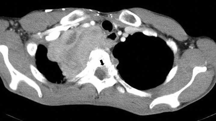 On contrast enhanced CT, the paraspinal mass lesion showed highly enhancing features and some low-attenuation features, and an enhancing soft tissue lesion was also detected at the left epidural