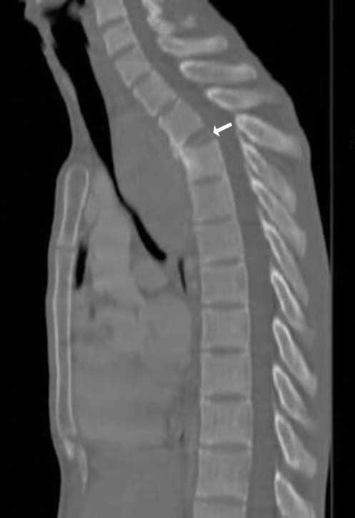 E F Fig. 1. E. The sagittal reformatted CT scan shows the total collapse of the T3 vertebral body (white arrow). F. The skeletal scintigram with Tc-99m hydroxymethylene diphosphonate shows uneven intense hot uptake in the T3 and T4 vertebral bodies.