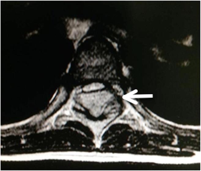 Preoperative sagittal post-contrast T2W showed intense homogeneity with significant enhancement. administration [12].