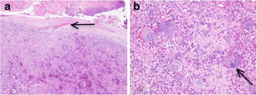 Siribumrungwong et al. Journal of Medical Case Reports 2013, 7:178 Page 4 of 5 Figure 4 Histopathology images of the tumor. a. Low-power hematoxylin and eosin stain.