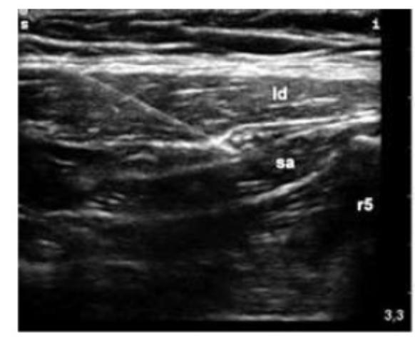 Injection between Latissimus dorsi and serratus anterior at roughly 5 th rib level Used for rib fractures, VATs, and lat