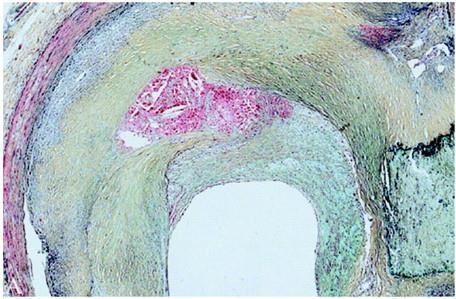 Damage and repair in the natural history of atherosclerosis Troponin I in