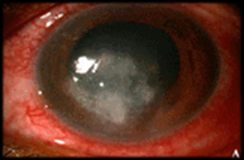 Lagenidium sp. Ocular Infection Mimicking Ocular Pythiosis U Riengprayoon et al., JCM 2013:51(8):2778 43 yr.