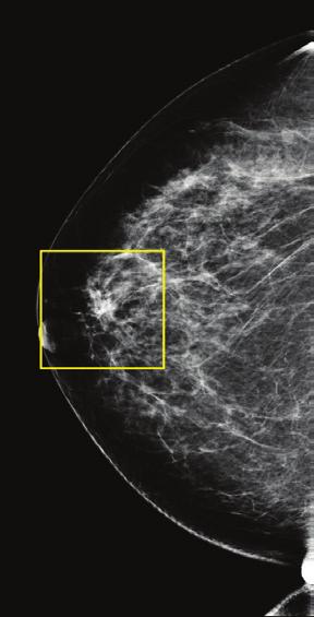 2,3 In addition, the Genius exam fi nds cancers earlier than 2D mammography alone, with a 41% increase in invasive cancer detection.