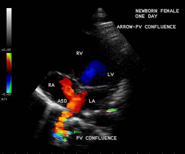 connection (SVC type TAPVC) in a newborn. Figure 21.