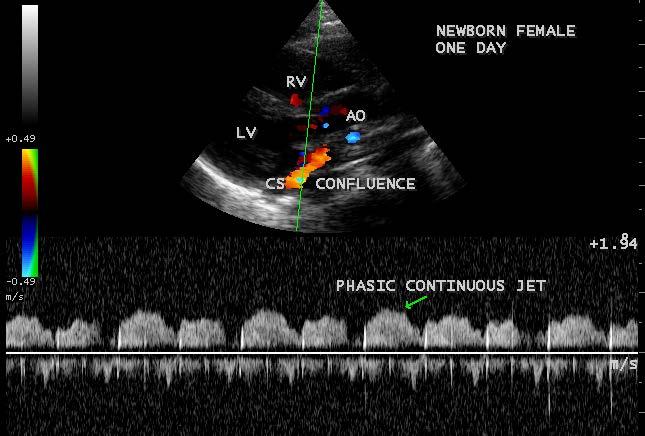 Figure 22. CW (Continuous Wave) Doppler Showing the phasic continuous jet of CS (coronary sinus) confluence in a newborn. physiology is similar to other ASDs.