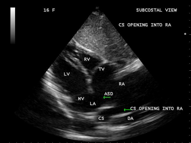 Parasternal long axis view showing the opening of coronary sinus into
