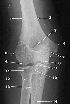 Putting it Together 1 lateral supracondyle ridge 2 medial supracondyle ridge 3 olecranon fossa 4 medial epicondyle 5 lateral epicondyle 6 capitulum 7 olecranon 8 trochlea 9 coronoid process of ulna
