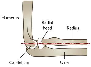 Radiographic Lines RADIOCAPITELLAR LINE ANTERIOR HUMERAL LINE http://www.rch.org.