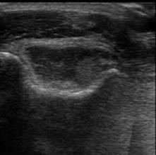 Elbow Ultrasound
