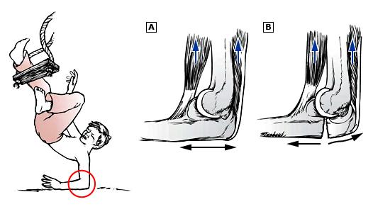 Olecranon Fx Mechanism of flexion injuries.