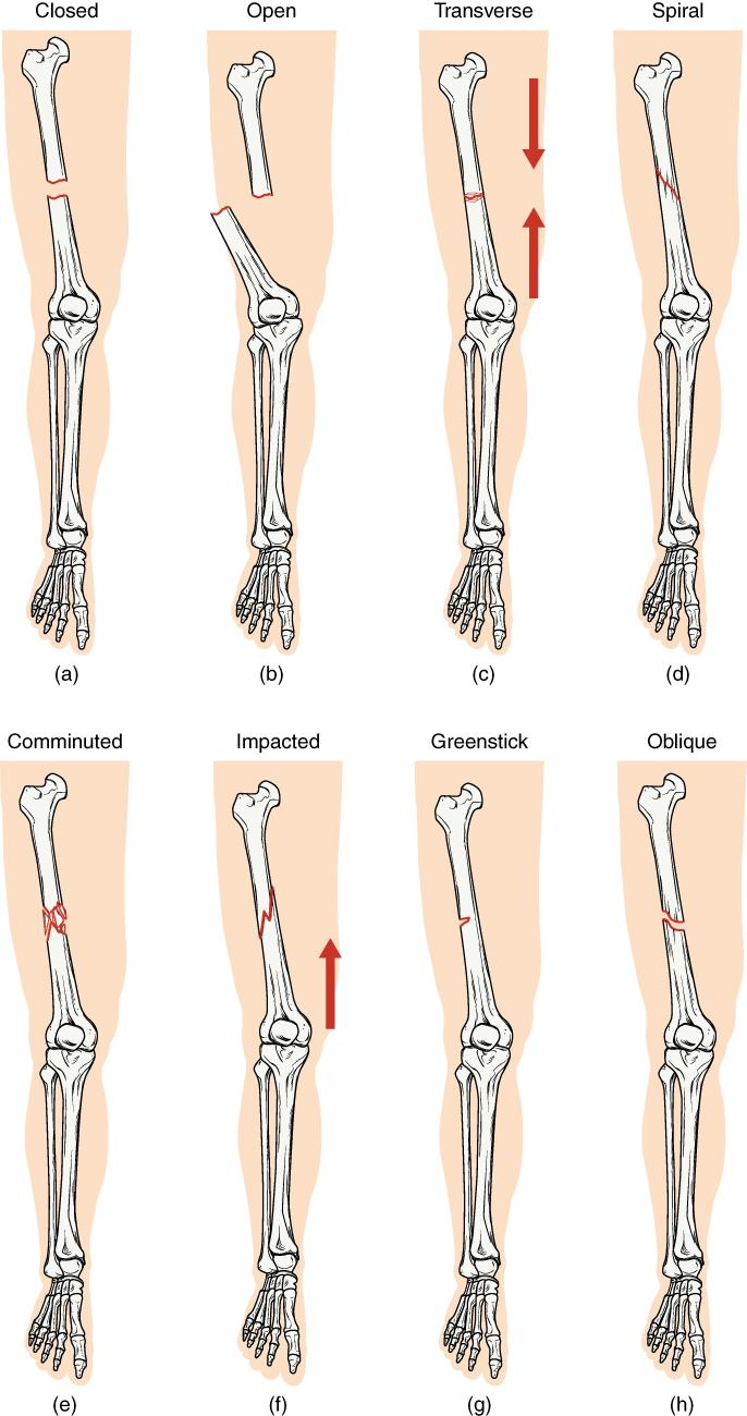 Fracture Description Bony anatomy Joint anatomy