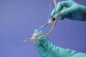 Remove the tube from the packaging and attach a 10-cc syringe without a needle to the cuff connection port near the top of the tube Inflate the distal cuff using no more than 10 cc of air and