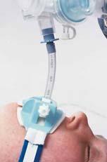 Following confirmation for correct placement, securing the tube is the next priority Assist the ALS provider in applying a commercially available endotracheal tube holder or by using a preferred
