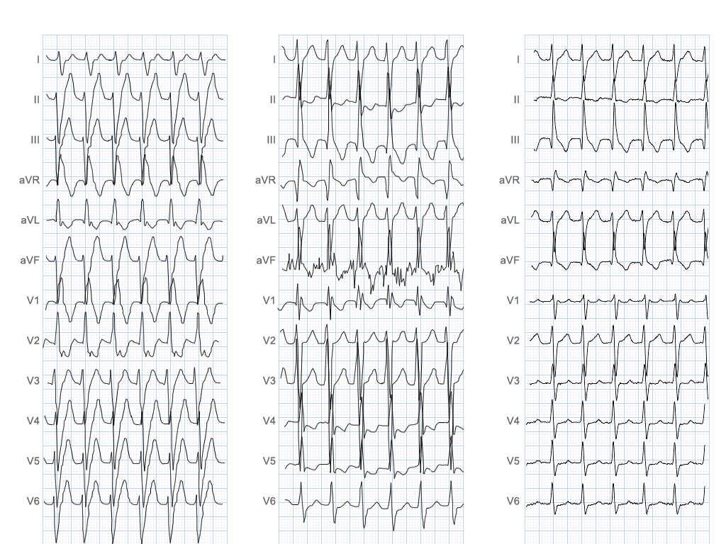 NF 25 year old male with narrow and WCT tachycardia. No past history of cardiac disease LVEF = 60%.