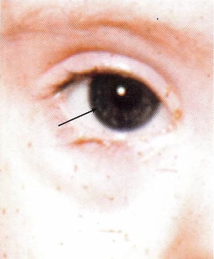 Eyes: Brushfield spots (speckling of iris Iris hypoplasia Refractive errors (mostly myopia) Lens
