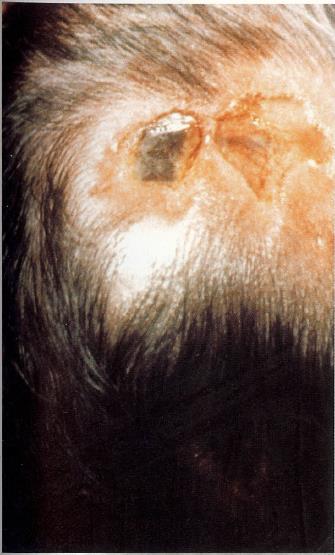 Skin: Capillary hemangioma Scalp
