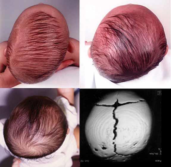 Plagiocephaly: Asymmetric head shape, which is usually a combination of unilateral