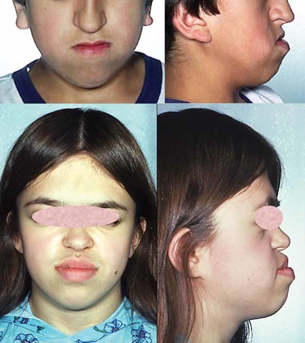 Midface Retrusion: Posterior positioning and/or vertical shortening of