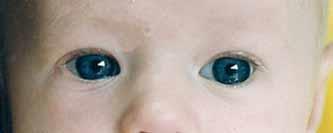 Palpebral Fissure, Almond- Shaped: A shape created by an acute downward arching of the upper eyelid and upward arching of the lower eyelid, toward the medial canthus, which