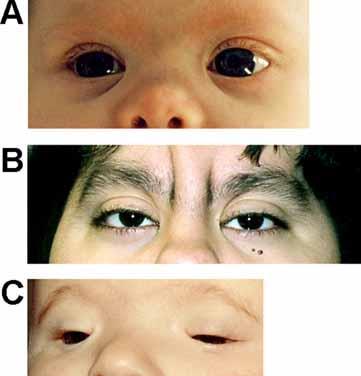 Epicanthus: A fold of skin starting above the medial aspect of the upper eyelid