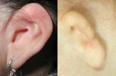 SD below the mean Microtia, Second Degree: Median