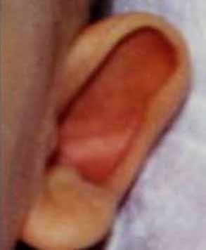 Ear, Protruding: Angle formed by the plane of the ear and the mastoid bone