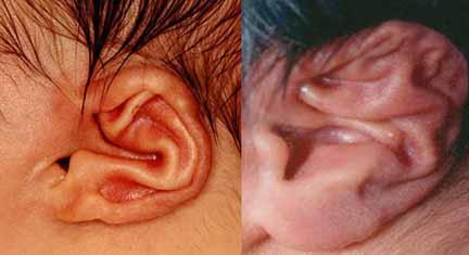 2 cm from the mastoid at the point of maximum distance Ear, Cupped: