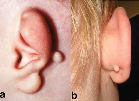 Tag, Auricular: Small protrusion