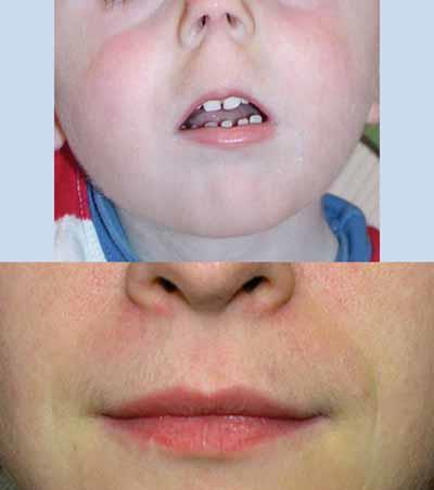Philtrum, Smooth: Flat skin surface, with no ridge formation in the central
