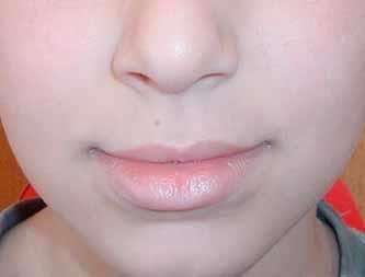 view Lower Lip, Thick: increased height of