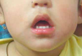 Upper Lip, Tented: Triangular appearance of the oral