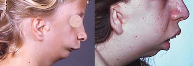 Retrognathia: Posteriorly positioned lower jaw, which is set back from the