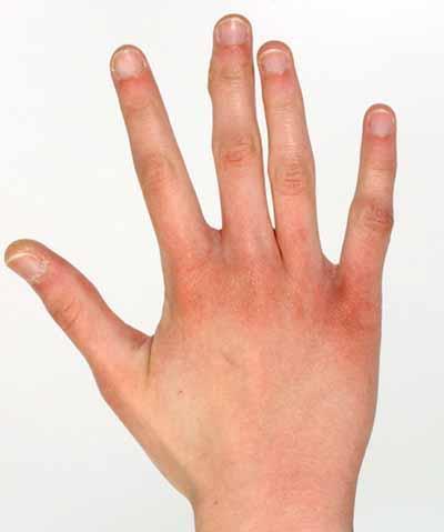 hand Fingers, Long (Arachnodactyly): fingers