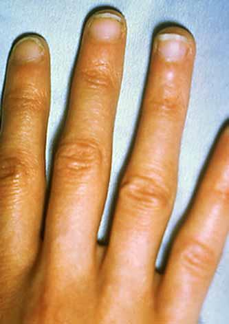 Finger, Slender (Narrow, Arachnodactyly, Thin): Digits