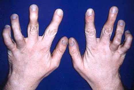 Camptodactyly: The DIPJ and/or PIPJ of the fingers cannot