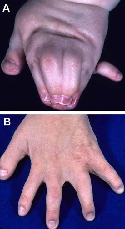 Fingers, Cutaneous Syndactyly of: A soft tissue continuity in the A/P axis between two fingers that lies