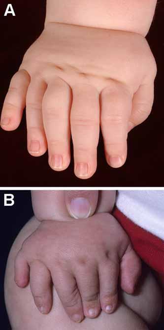 Hand, Postaxial Polydactyly of: Presence of