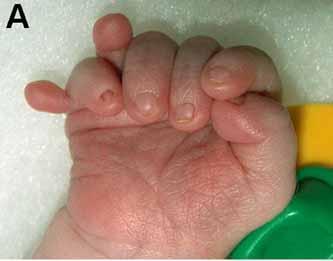 Hand, Polydactyly, Mesoaxial: The presence of a supernumerary finger (not a