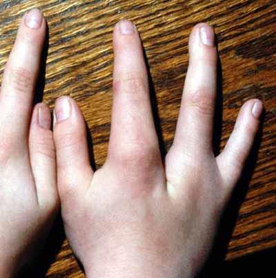 Hand, Split: Longitudinal deficiency of a digital ray of