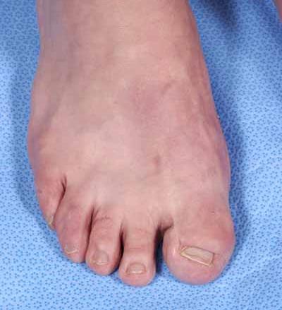 size or build of the individual Toe, Broad: increase in width