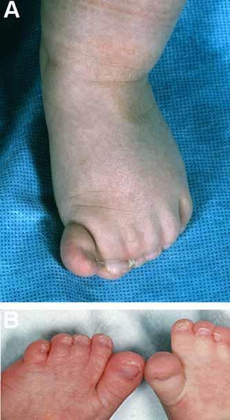 Toes, Cutaneous Syndactyly of: A soft tissue continuity in the A/P axis